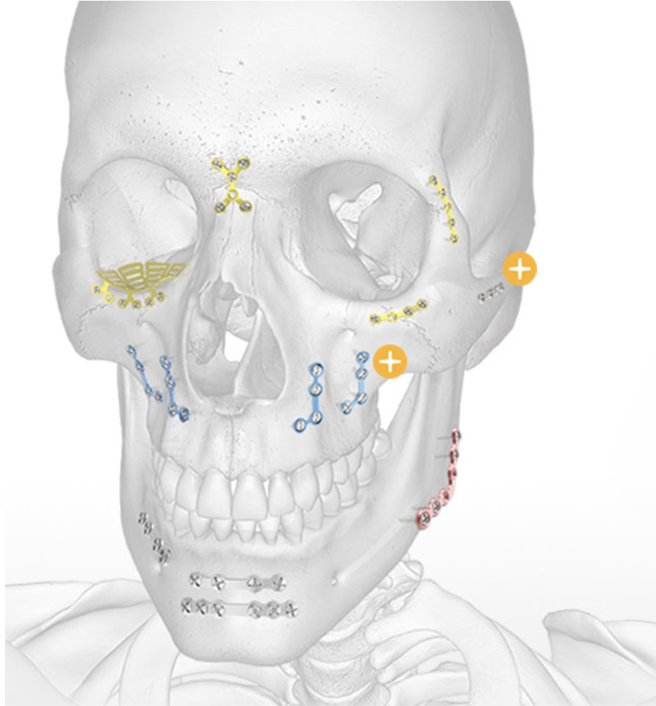 Craniomaxillofacial System