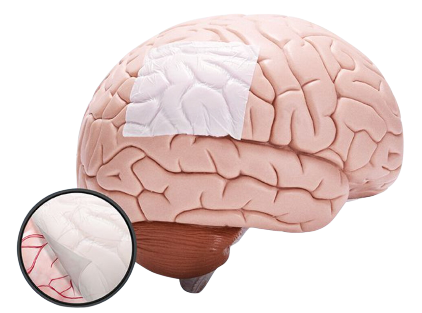 Absorbable Dural Patch