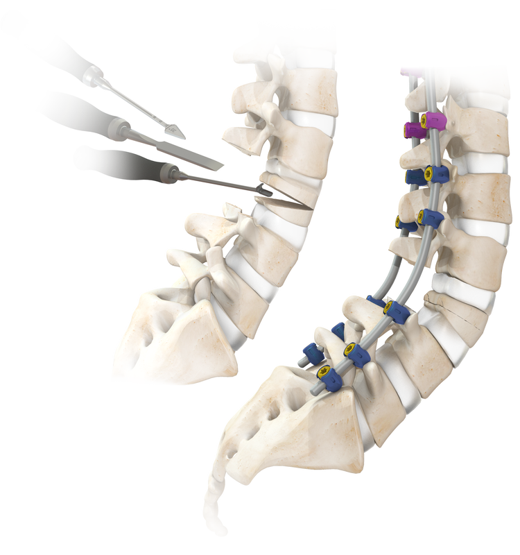 Spine System With Single Lead Thread Screws (Degenerative)